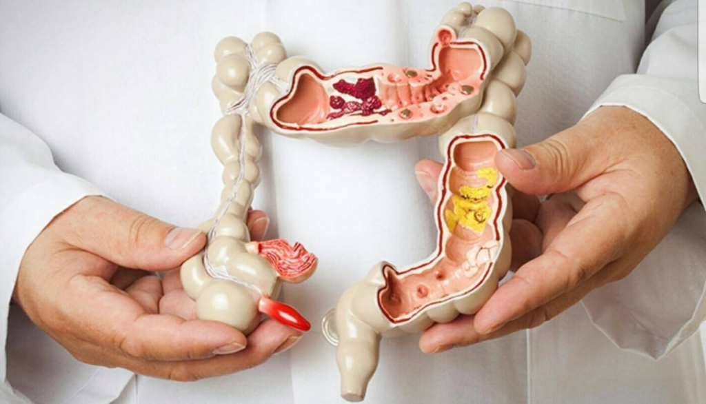 健康-醫療科技-疾病資訊-癌症-大腸癌
