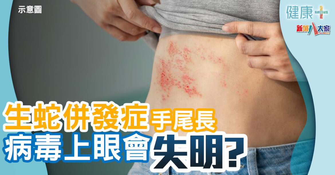 生蛇風險｜生蛇併發症手尾長　病毒上眼會失明？