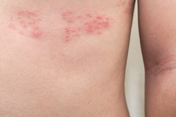 健康-疾病資訊-生蛇風險-帶狀疱疹-併發症