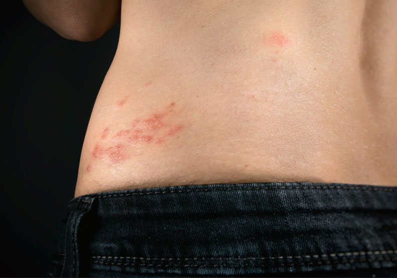 健康-疾病資訊-生蛇風險-帶狀疱疹-併發症