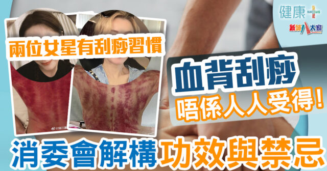 刮痧療法|血背刮痧唔係人人受得 消委會解構功效與禁忌 健康-時令養生-自然療法-消委會-刮痧