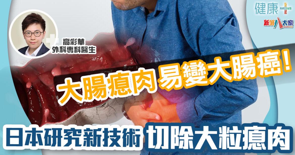 醫療科技｜大腸瘜肉高風險變大腸癌！日本研究新技術切除大粒瘜肉