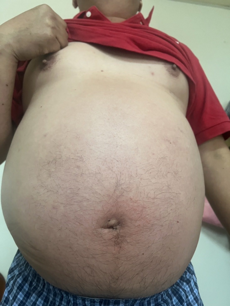 健康-疾病資訊-心臟病-大肚男-行山休克