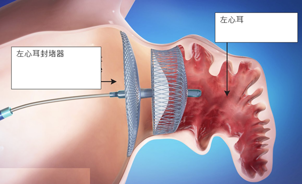 健康-心血管健康-心臟病-心房顫動-中風