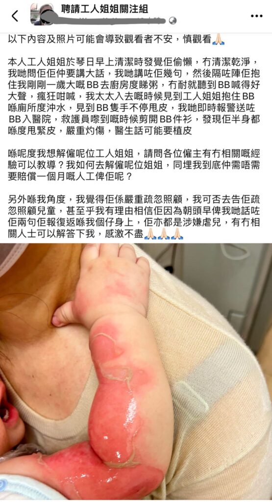 虐兒-外傭-灼傷-熱話1