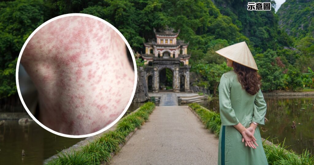 健康-疾病資訊-傳染病-麻疹