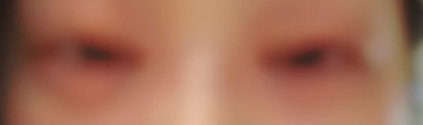 娛樂-郭柏妍-食物中毒-食物敏感-致敏原