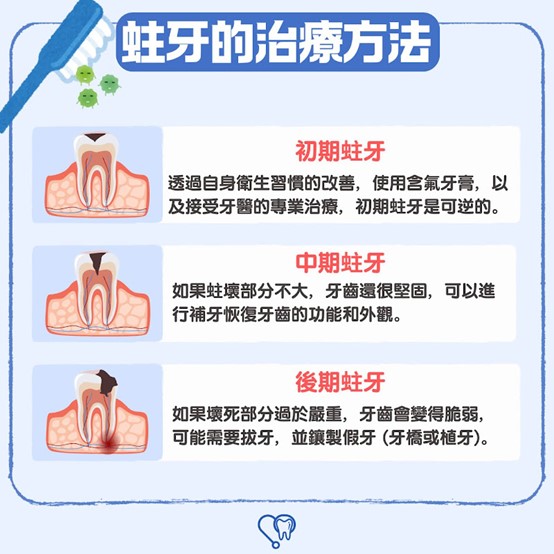 蛀牙-健康-伍裕彤醫生-治療3