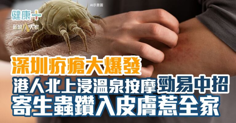 深圳疥瘡大爆發 港人北上浸溫泉按摩勁易中招 寄生蟲鑽入皮膚惹全家